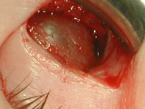 Orbital Tumors - Lacrimal Sac 